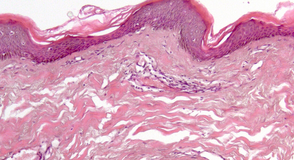 Biopsia cutanea