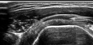 litoclasia percutanea ecoguidata di spalla