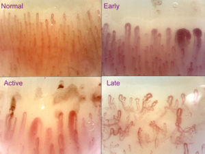 Scleroderma pattern