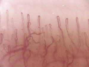 Capillaroscopia
